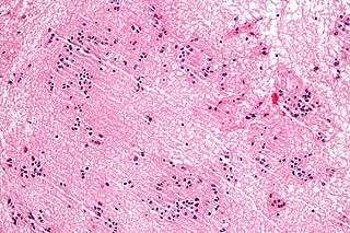 Subependymoma Relatively benign brain cancer involving ependymal cells