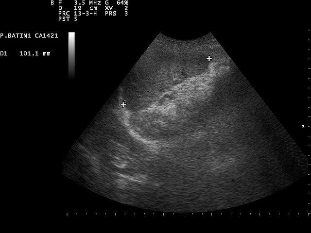 eFAST: extended Focused Assessment with Sonography in Trauma 