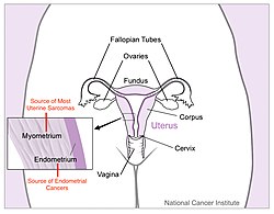 Діаграма матки з позначеними вогнищами раку.
