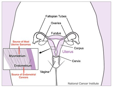 Diagram of uterus with labelled origins of cancer types.