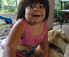 A child with an unspecified MPS disorder, showing characteristic facial features