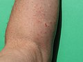 Herpes zoster - male, 62 years old - left arm skin - outbreak in remission - 2, 2019.jpg