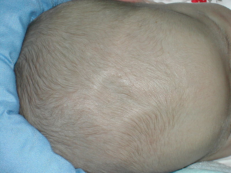 File:Human anterior fontanelle 1 month dscn1449.jpg