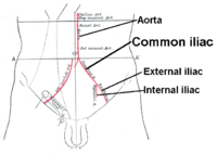 Iliac artery bifurcation and aorta.PNG