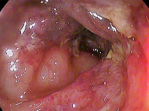 Ischemic colitis t-colon.jpg