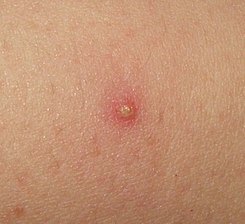 staphylococcus folliculitis #11