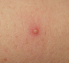 Isolated folliculitis.jpg