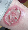 Leishmaniasis ulcer.jpg