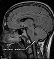 MRI mozku zobrazující herniaci cerebellárních tonzil do foramen magnum u pacienta s Arnoldovo-Chiariho malformací prvního typu.