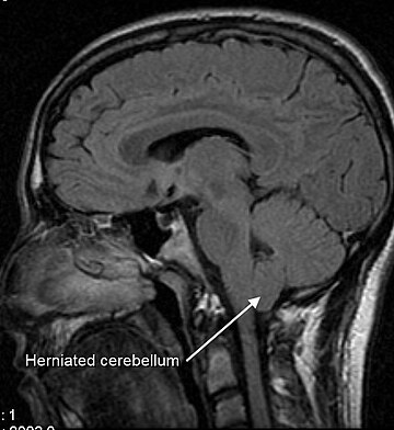 Chiari malformation