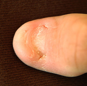 Nail–patella syndrome - Wikipedia