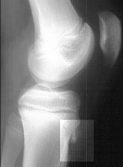 Osgood-Schlatter disease X-ray.JPEG