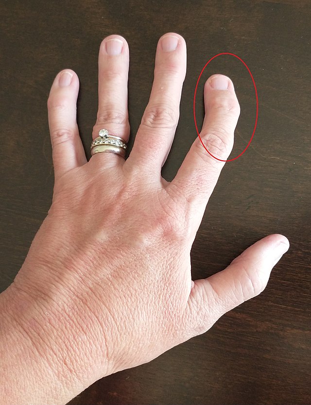 Arthrosis ujjak kezelése. A kéz leggyakoribb betegségei