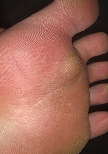 A plantar fibroma right below the 2nd toe. Plantar fibroma on foot.jpg