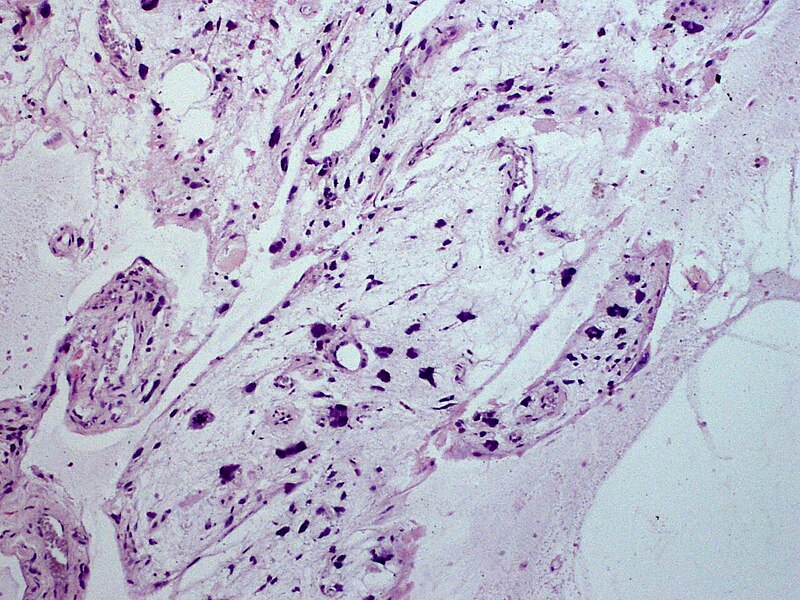 File:Skin Tumors-PA030909.jpg