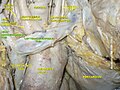 Vena brachiocefalică dreaptă și stângă