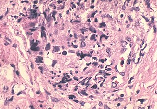 <span class="mw-page-title-main">Sperm granuloma</span> Lump of extravasated sperm found in some vasectomized men