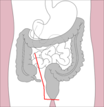 Total proctocolectomy Total proctocolectomy.png