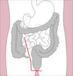 Colectomy