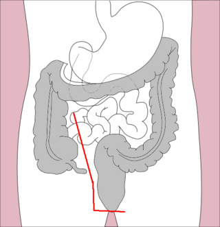 <span class="mw-page-title-main">Proctocolectomy</span>