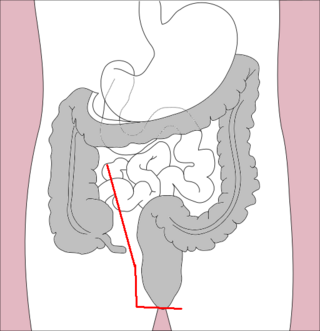 <span class="mw-page-title-main">Proctocolectomy</span> Surgical removal of the colon and rectum