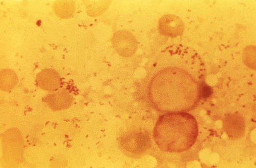 This photomicrograph of an unknown tissue sample, revealed the presence of numerous, Gram-negative, Coxiella burnetii bacteria, which are the pathogens responsible for causing the disease, Q fever