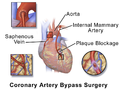 Illustration depicting coronary artery bypass surgery (double bypass)
