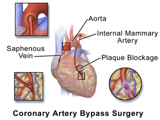 Coronary artery bypass surgery.