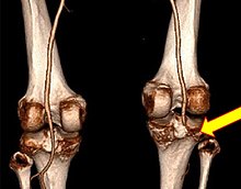 signs and symptoms of patellar dislocation