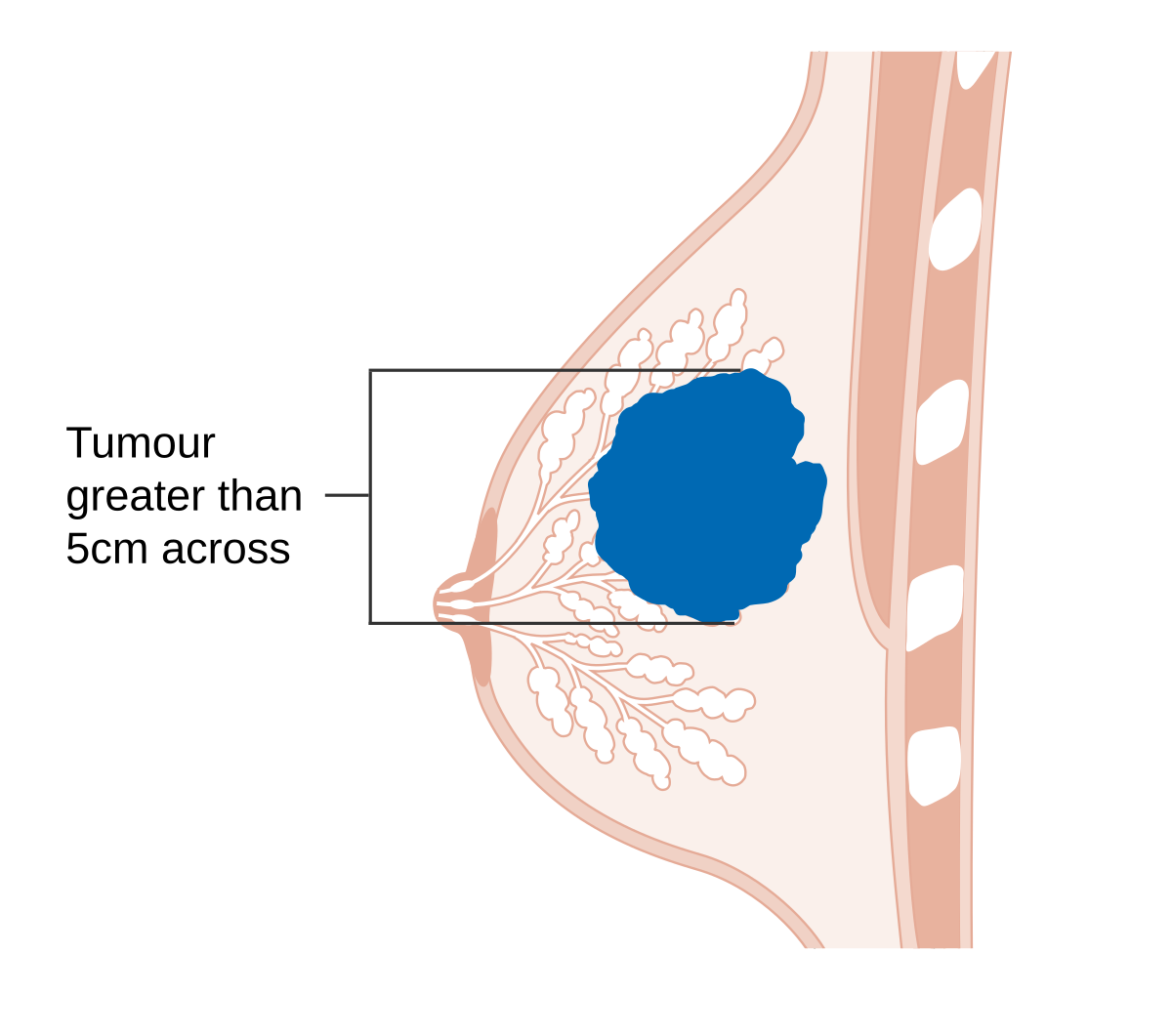 Ficheiro:Diagram 1 of 2 showing stage 3B breast cancer CRUK 004.svg –  Wikipédia, a enciclopédia livre