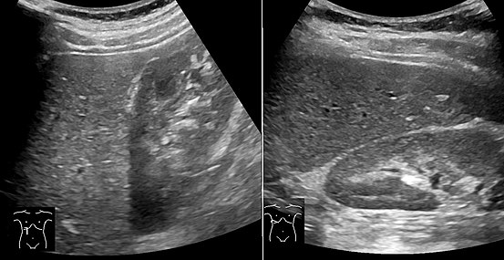 Abdominal ultrasonography with the liver and kidney side by side (left image) may give a false impression of hyperechogenic liver, so it's preferably done with the organ borders facing the ultrasound probe (right image, of the same case).