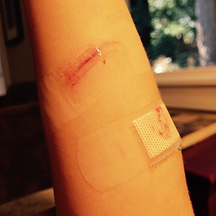 An incision wound closed with Dermabond, a cyanoacrylate-based medical adhesive
