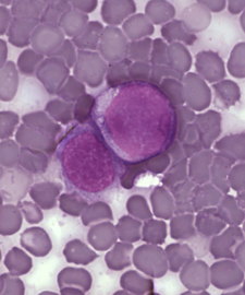 Leukemické buňky v nátěru z periferní krve