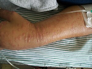 Mycosis fungoide.JPG