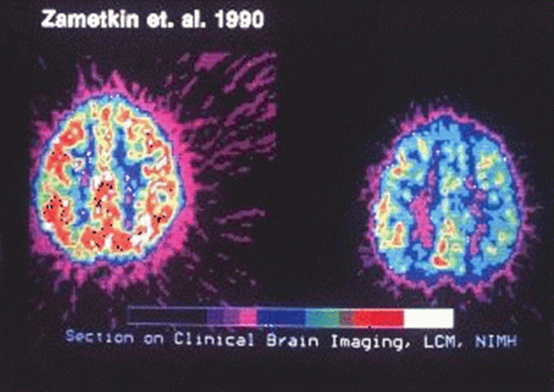 Brain scans of brains with and without ADHD.^[[Image](https://en.wikipedia.org/wiki/File:NewADHDpic.gif) by the [National Institutes of Health](https://www.nih.gov/) is in the public domain]