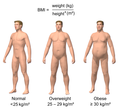 Thumbnail for Classification of obesity