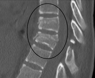 <span class="mw-page-title-main">Chance fracture</span> Medical condition