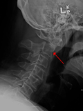 Miniatura para Fractura cervical