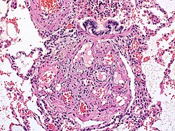 Pulmonell Arteriell Hypertension: Sjukdom som innebär att lungornas blodkärl blir för trånga