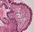 الأمعاء الدقيقة تظهر ترسبا نشوانيا، ميكروسكوب ضوئي 20x تكبير (بالإنجليزية:Small bowel duodenum with amyloid deposition)