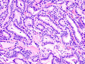 Thyroid papillary carcinoma histopathology (2).jpg