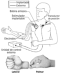 Miniatura para Neuroprótesis