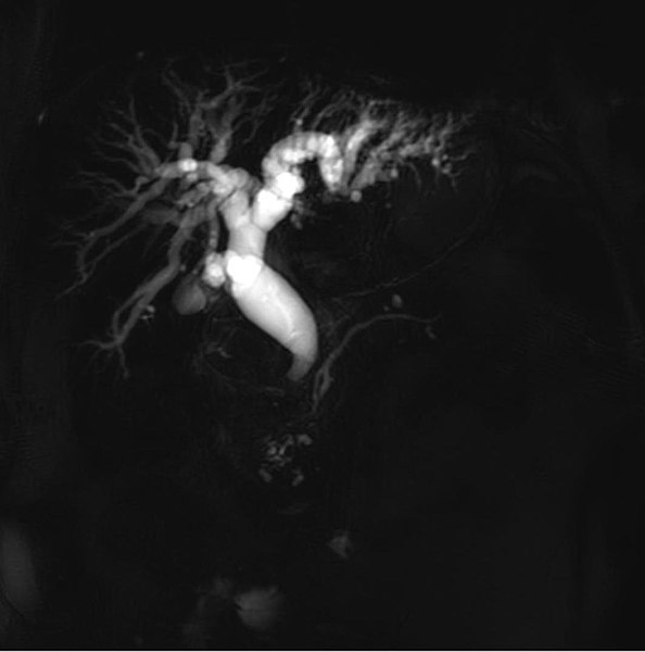 File:Adenokarzinom des Duodenums 65M - MR single shot MRCP - 001.jpg