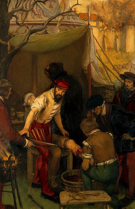 Развитие хирургии в средние века. Хирург Амбруаз паре. Амбруаз паре французский хирург. Французский хирург Амбруаз паре (1510—1590).