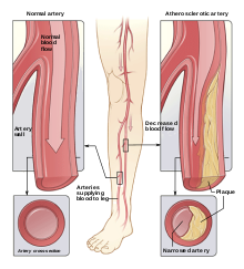 Arteriopatia obliteranta a membrelor inferioare