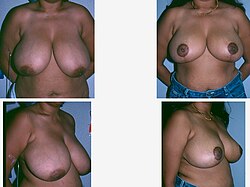 Breast Reduction-four-plate photograph.jpg