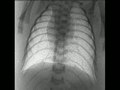 File:Changes-in-Positive-End-Expiratory-Pressure-Alter-the-Distribution-of-Ventilation-within-the-Lung-pone.0093391.s002.ogv