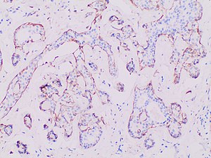 Fibrocystic breast changes - Wikipedia