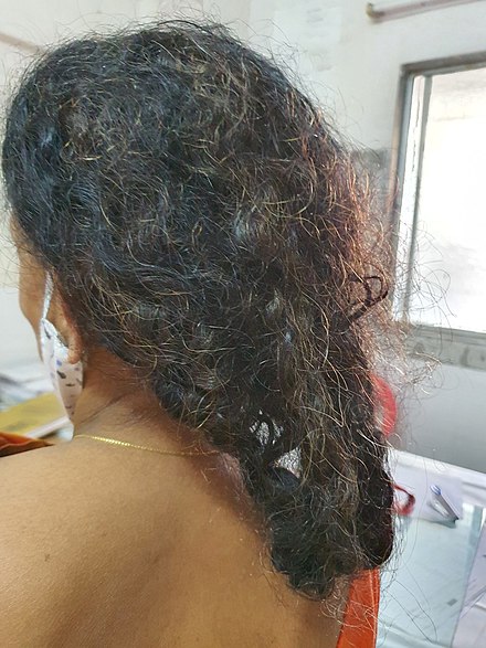 Hair matting after few sessions of chemotherapy