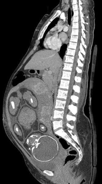 File:Median plane CT scan of a pregnancy of 37 weeks of gestational age.jpg